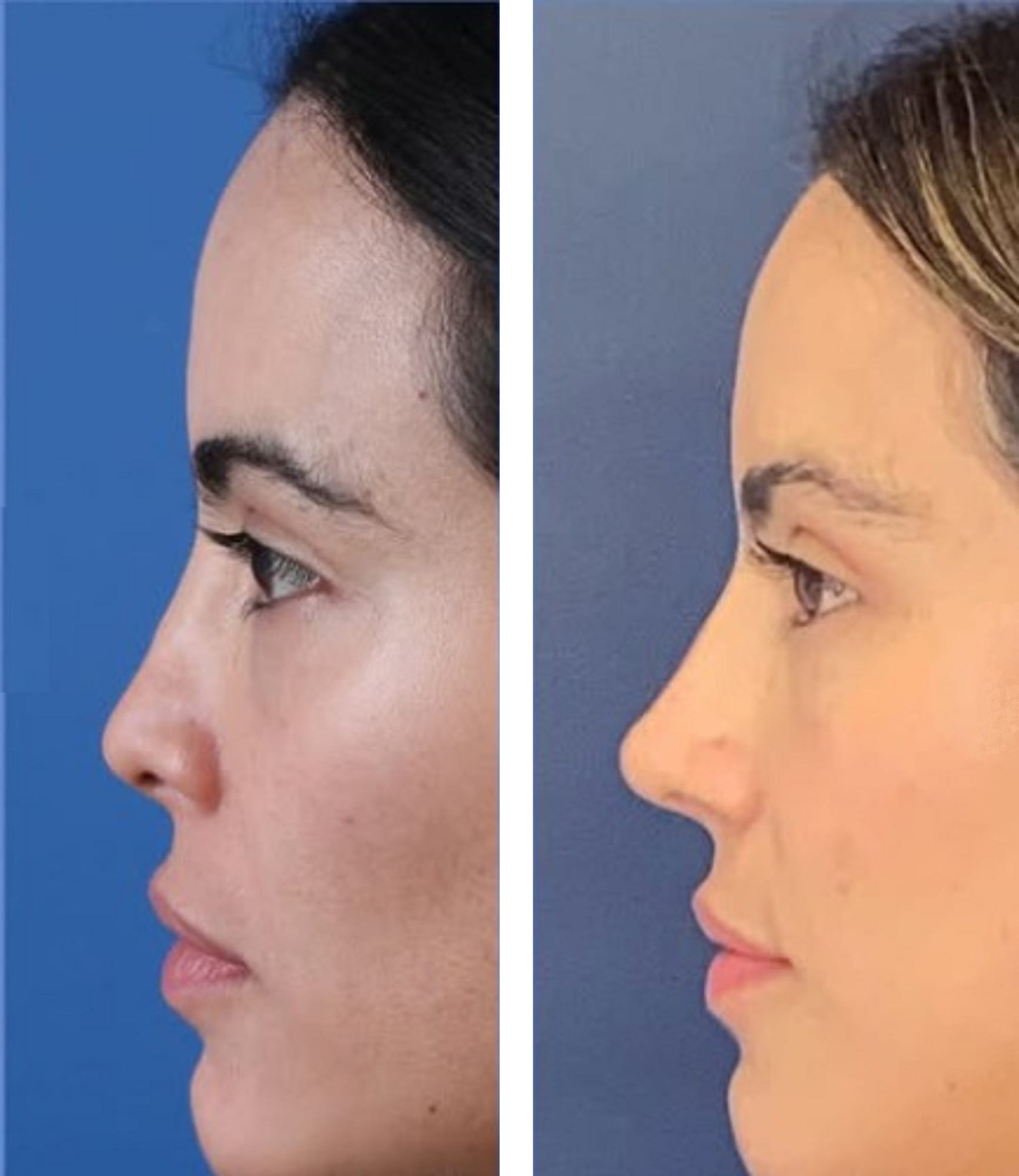 Rinoplastia caso 4 — antes y después